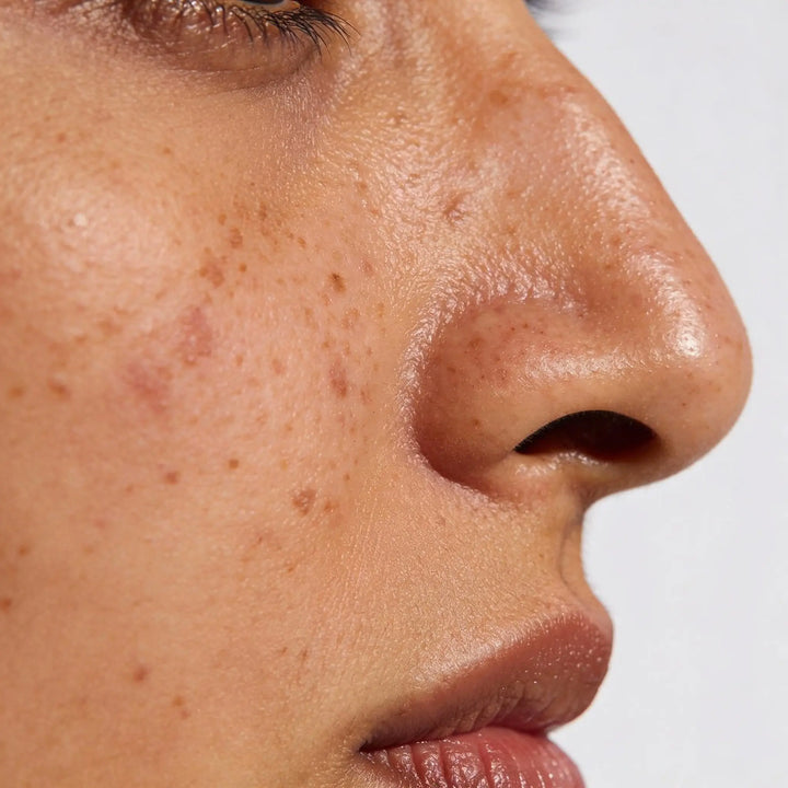 Dark Spots & Pigmentation