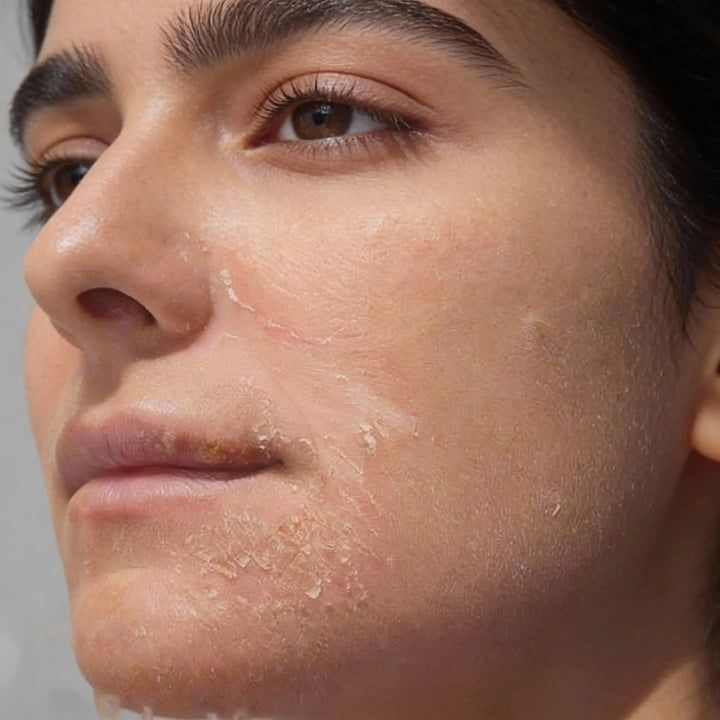 Dry & Dehydrated Skin